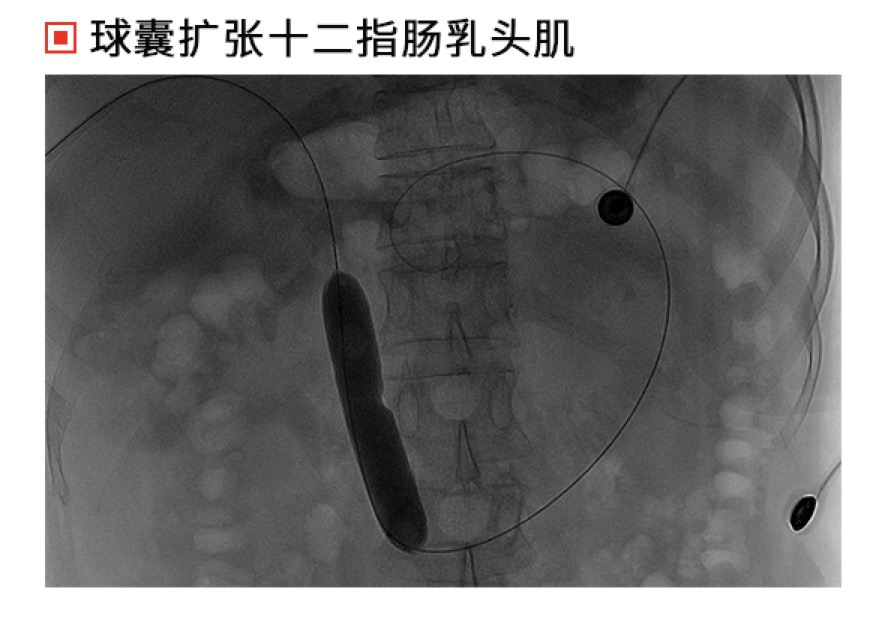 我院完成首例经皮穿肝十二指肠乳头肌扩张排石术 - 曲阜市人民医院